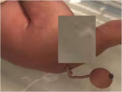 حالة طبية نادرة.. ولادة طفل بذيل وكرة بنهايته في البرازيل - وكالة انباء الرأي العام منوّعات